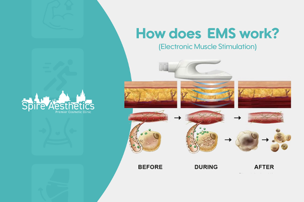 EMS treatment for post pregnancy weight loss treatment Northamptonshire