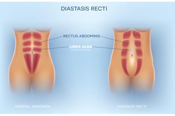 What Non-Surgical Options Are Available for Diastasis Recti Northamptonshire?