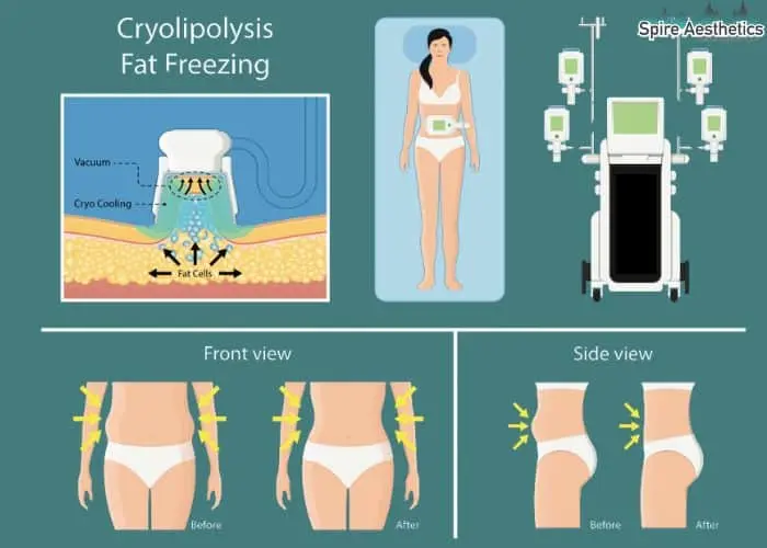 Fat freezing treatment Northamptonshire benefits for competitions to remove stubborn fat deposits.