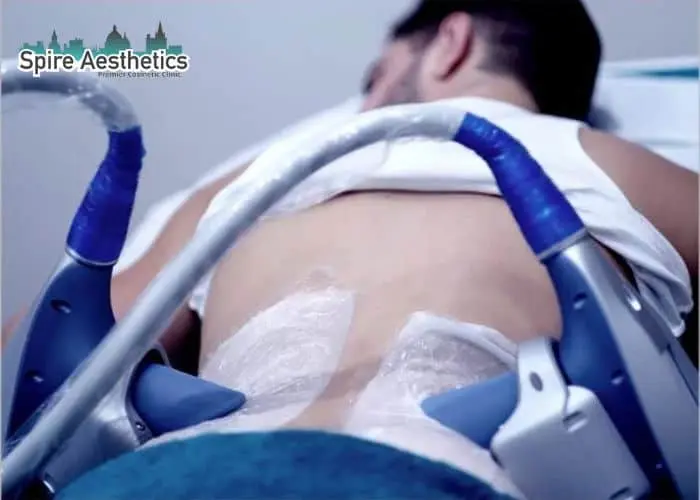 Man having fat freezing treatment done on love handles before a competitions Northamptonshire to create a sculpted look.