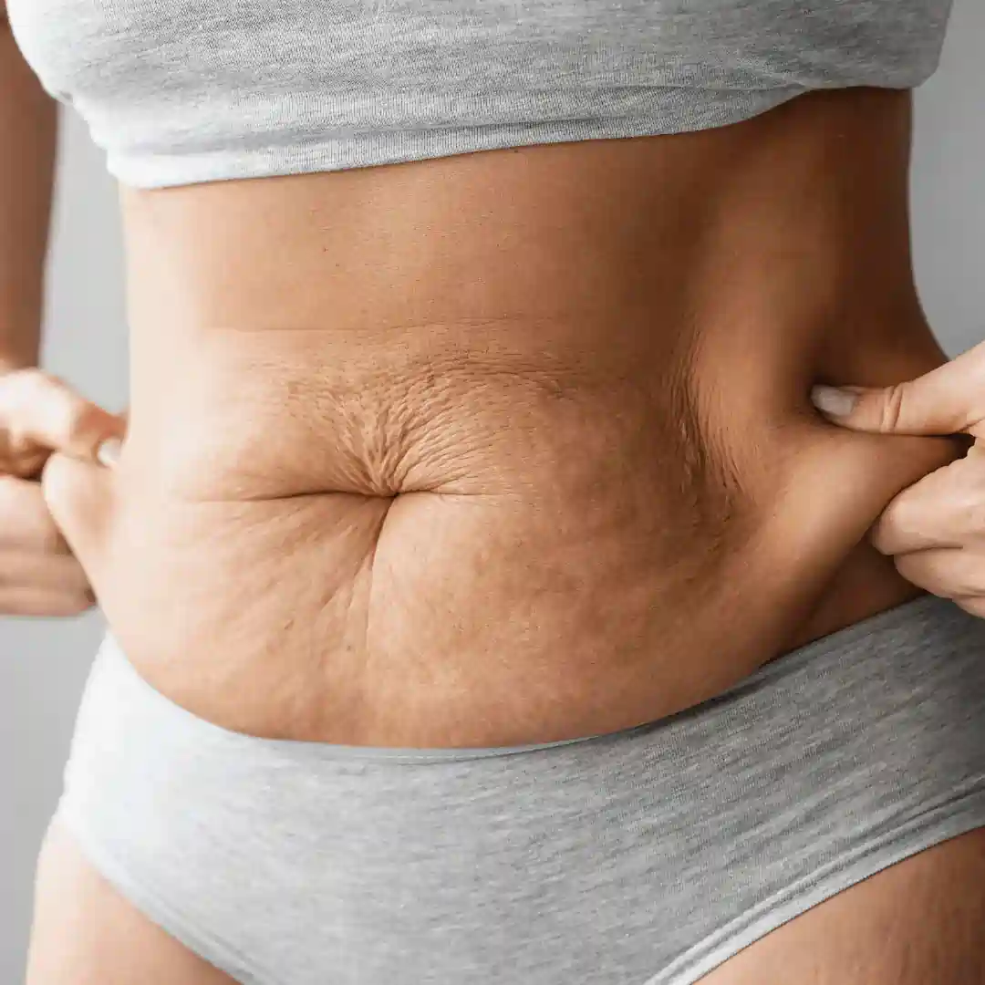 Is It Normal to Have Loose Skin After Pregnancy Northamptonshire?