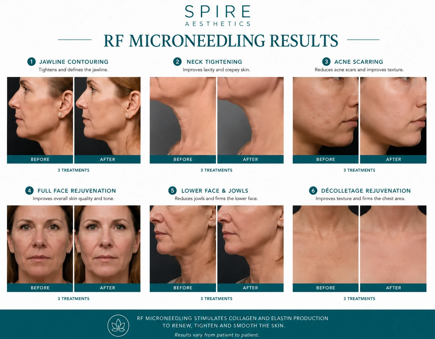 RF Microneedling Skin tightening Northamptonshire results