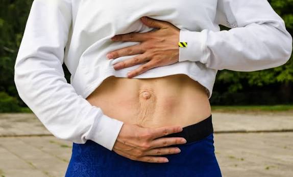 When Could Diastasis Recti Be the Missing Piece of the Puzzle Northamptonshire?