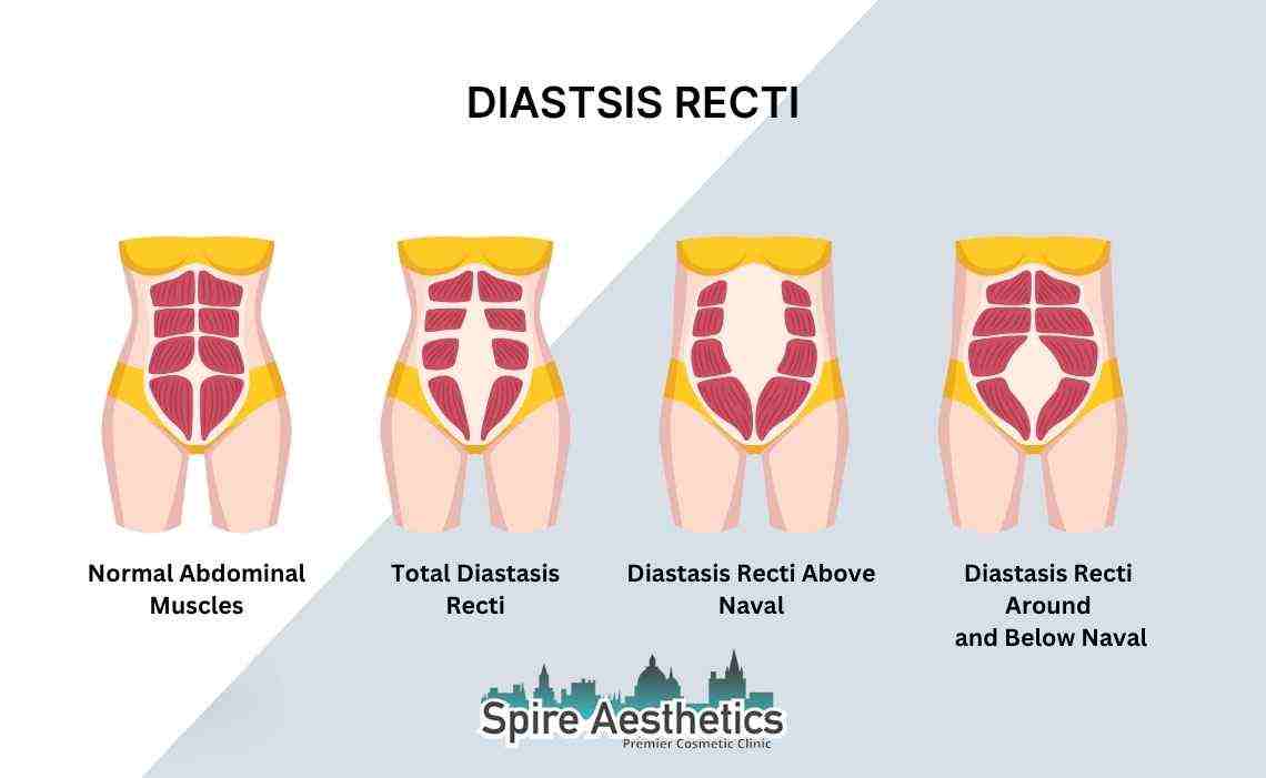 Is Non-Surgical Diastasis Recti Treatment Right for You? Common Concerns Answered Northamptonshire